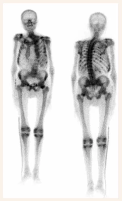 Nález na scintigrafii skeletu mnohočetného
postižení skeletu u pacienta s malabsorpční
osteomalacií při chronické pankreatitidě.
