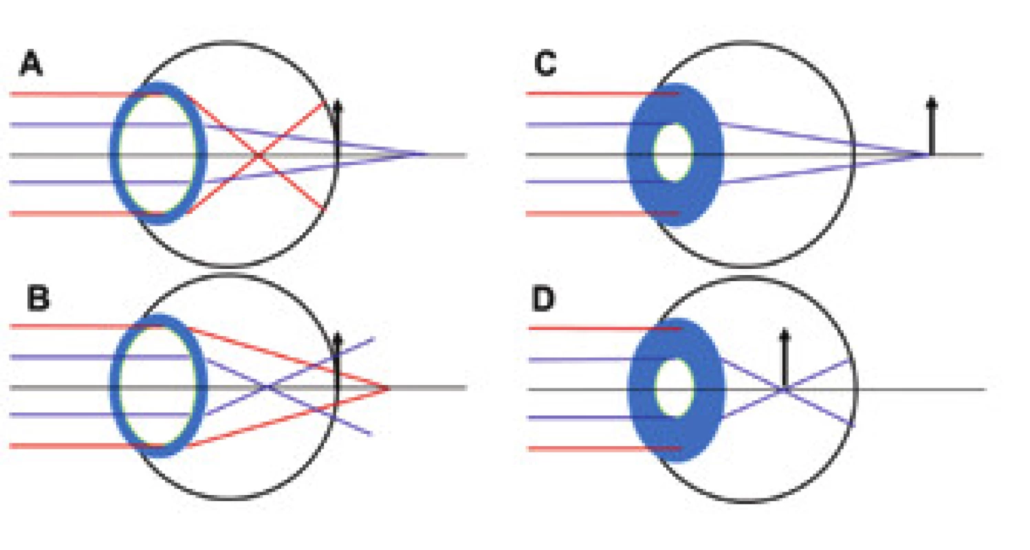 Emmetropic eyes with 6 mm pupil and positive (A), negative
(B) spherical aberration. The peripheral rays are refracted
more than the paraxial. Same eyes after accommodative
miosis (C and D). Elimination of peripheral rays and thereby
also SA causes a hypermetropic (C) and myopic (D) shift. In the
case of B-D there is therefore an improvement of near vision.
