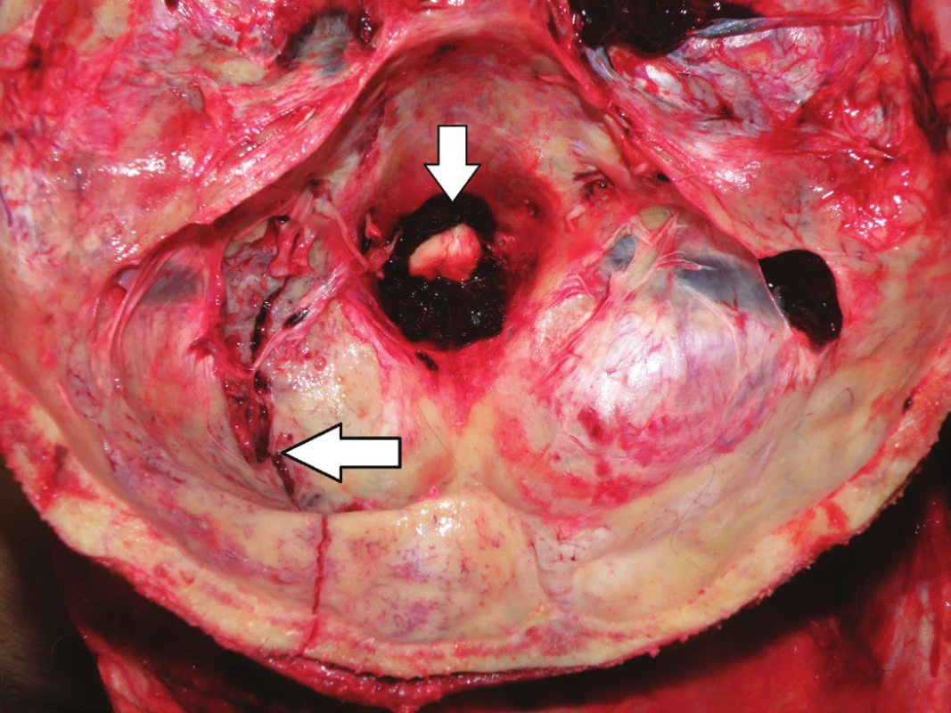 Fracture of the occipital and the left temporal bone running across
the sigmoid sinus (horizontal arrow) and spinal subdural hematoma (vertical
arrow).
