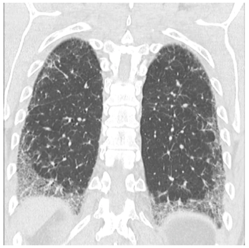 Intersticiální plicní proces u 50letého muže s idiopatickou zánětlivou myopatií charakteru antisyntetázového syndromu s pozitivitou anti-Jo protilátek; HRCT obraz fibrotickýc změn intersticia charakteru nespecifické intersticiální fibrózy (NSIP) 