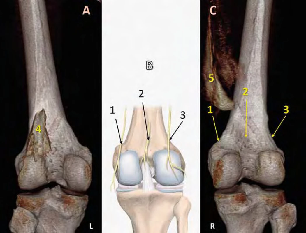 3D rekonstrukce distribuované tekutiny. 1. n. genicularis superior medialis, 2. genikulární větev z n. ischiadicus, 3. n. genicularis superior lateralis,
4. distribuční prostor LVVDS, 5. distribuční prostor DAC, A. levá noha (LVVDS), B. ilustrační obrázek, C. pravá noha (DAC).