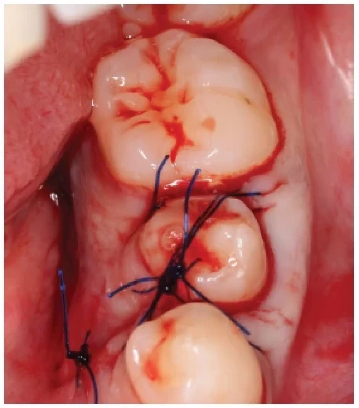 Stav po autotransplantaci
retinovaného premoláru 35. <br> 
Fig. 2.
The status after
autotransplantation
of impacted tooth 35.