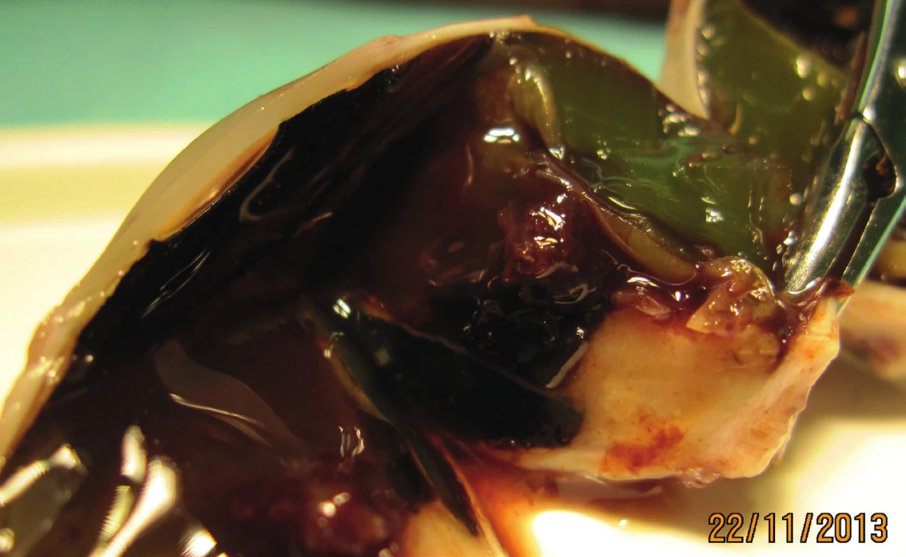Eyeball after enucleation – detail of tumour deposit and secondary amotio