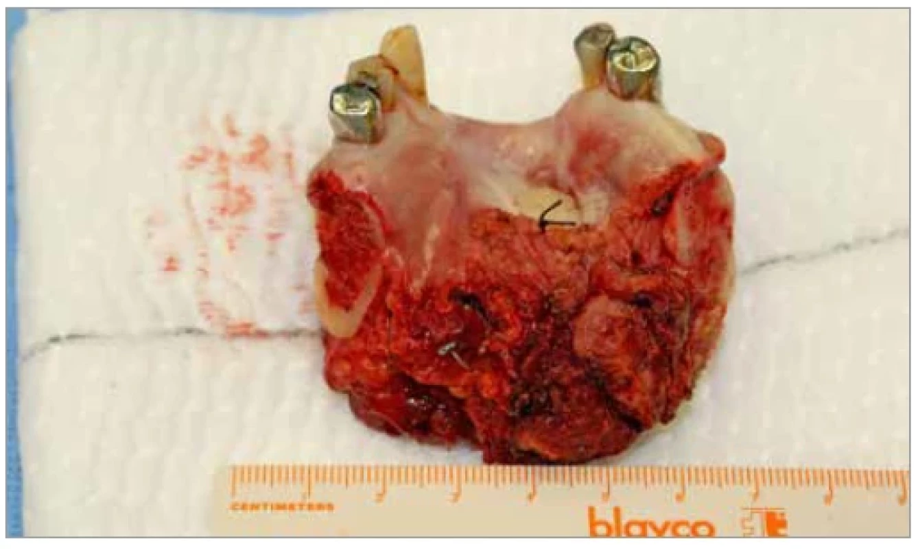 Resected tumor of the floor of the oral cavity. A surgeon is trying to
reach free margins of resection (R0) so that the distance between the tumor
mass margin and the healthy tissue is > 5 mm.