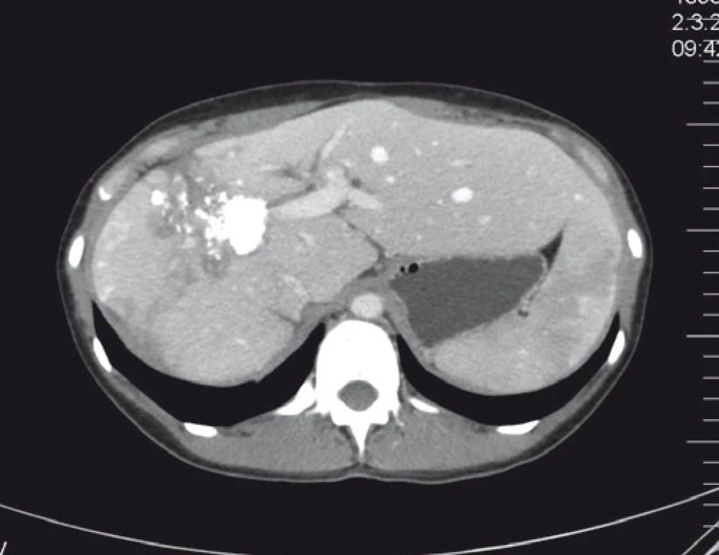 CT nález významné regrese po systémové léčbě.<br>
Fig. 4. CT scan of a significant regression after systemic
treatment.