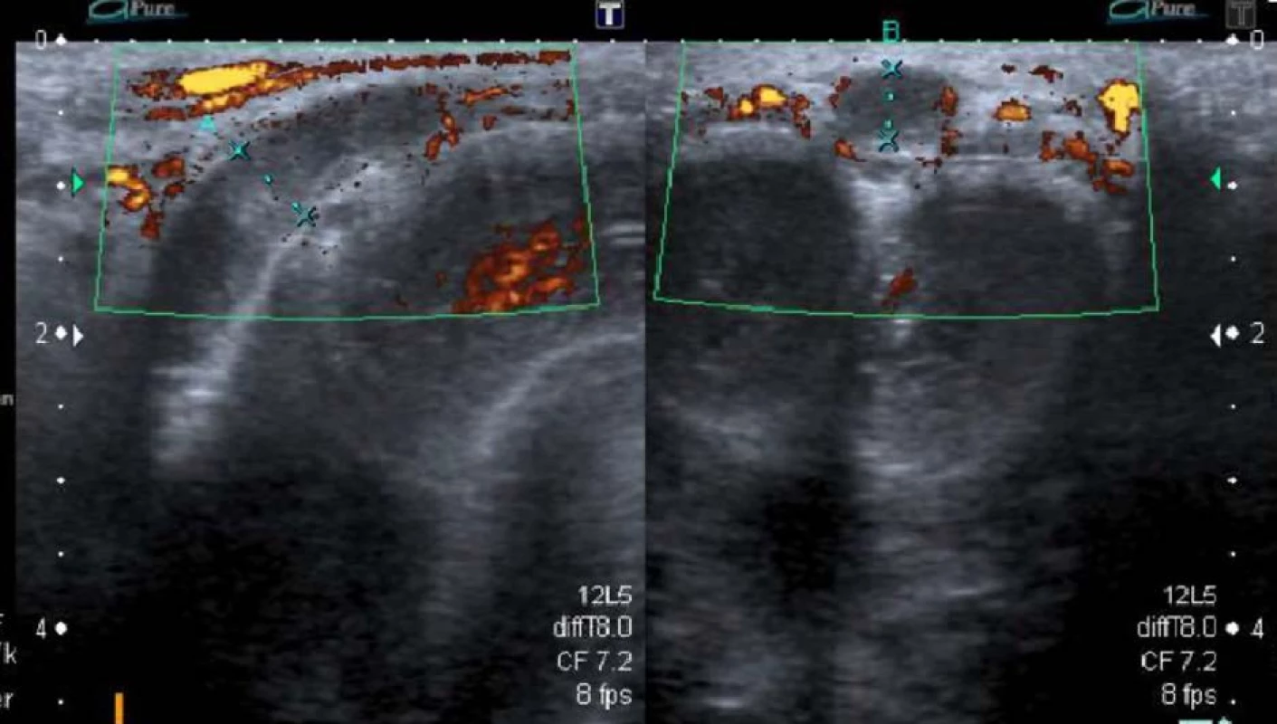 Ultrasonografie s užitím barevného dopplerovského vyšetření ukazující trombus a dilataci žíly (archiv autora )<br>
Fig. 2. Color Doppler scan showing the trombus and dilatation of the vein