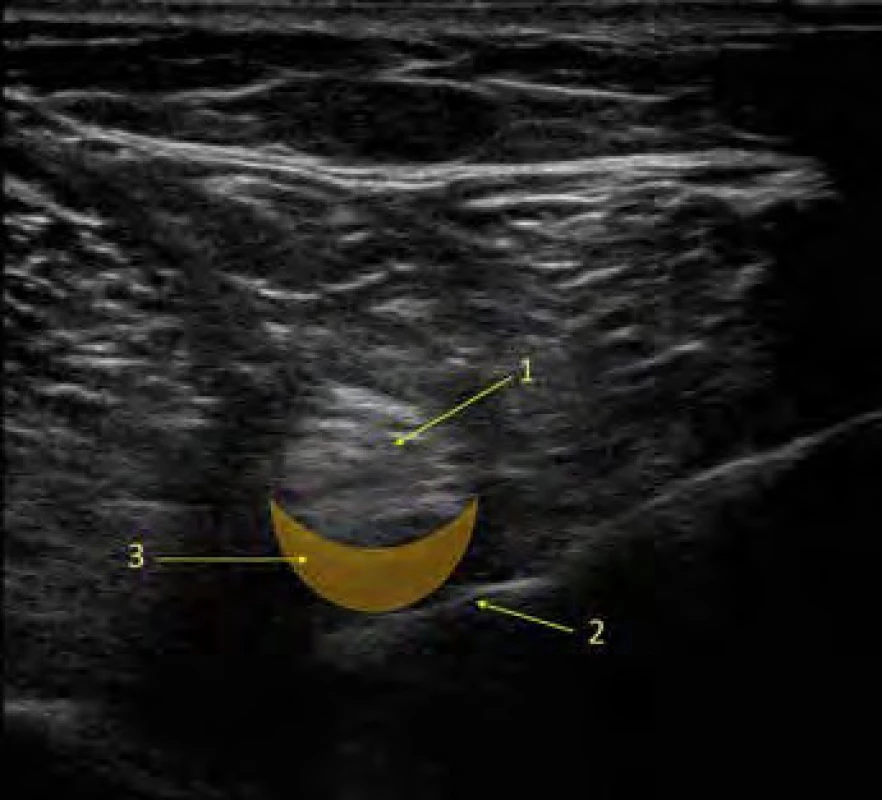 Low volume distal sciatic block. Na UZ obrázku ischiadického nervu
je žlutou barvou znázorněna oblast distribuce lokálního anestetika při LVDS
bloku. 1. ischiadický nerv, 2. jehla, 3. oblast distribuce lokálního anestetika.