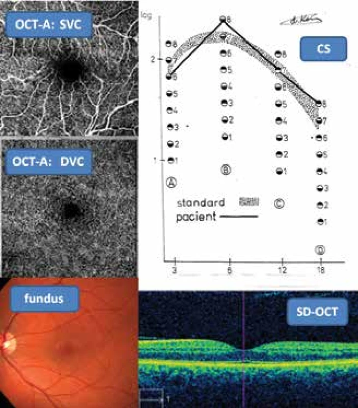 Fyziologický nález tří neinvazních vyšetřovacích
metod: CS, SD-OCT, OCT-A (povrchový/hluboký vaskulární segment
– SVC/DVC) a fotografie fundu