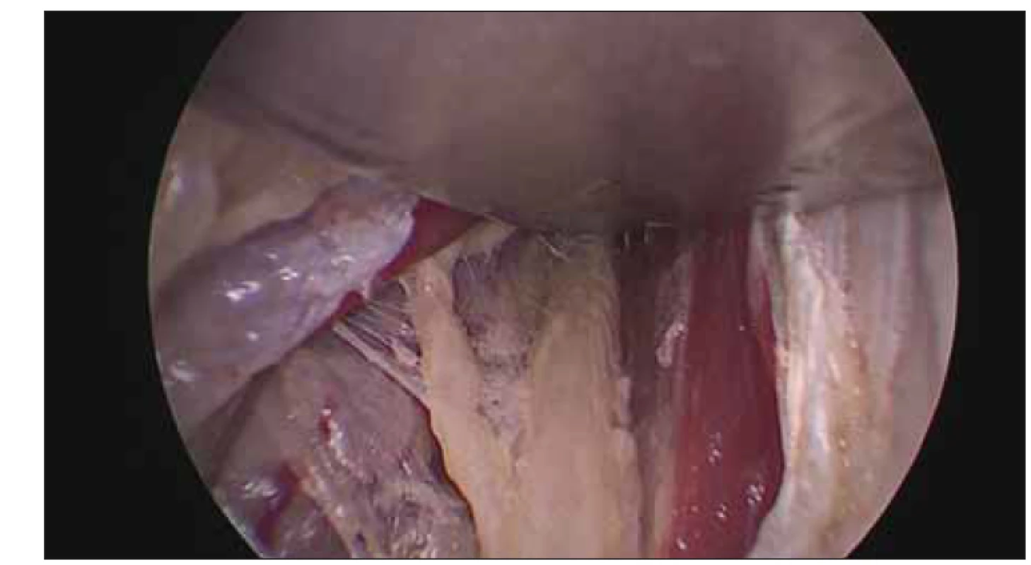 Odstupující nervová větev pro musculus fl exor carpi ulnaris.<br>
Fig. 5. Branch of the ulnar nerve for the fl exor carpi ulnaris muscle.