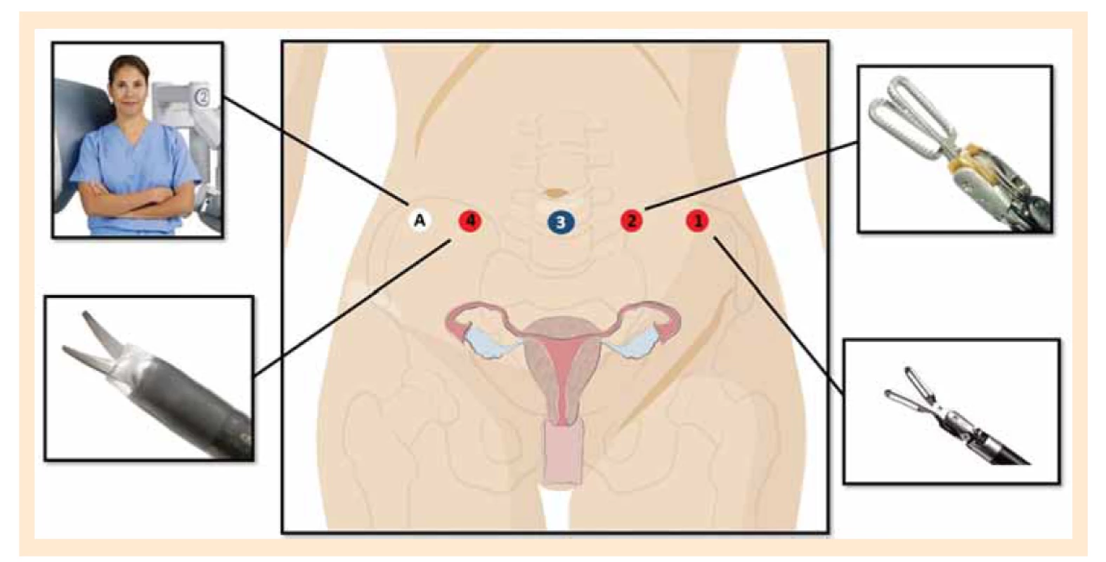 Rozmístění portů při robotem asistované pánevní lymfadenektomii (upraveno podle Intuitive Surgical).<br>
Fig. 3. Deployment of ports during robot-assisted pelvic lymphadenectomy (adapted from Intuitive Surgical).