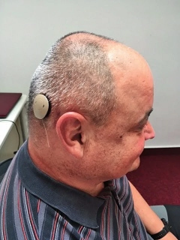 Pacient se zevním audioprocesorem 3 týdny po operaci.