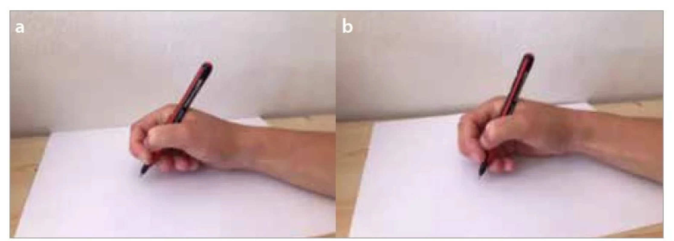 a,b. Boční palcový úchop s palcem pod ukazovákem – a) tříprstý,
b) čtyřprstý.<br>
Fig. 6a,b. Lateral thumb tuck grip – a) thumb tuck tripod, b) thumb tuck quadruped.