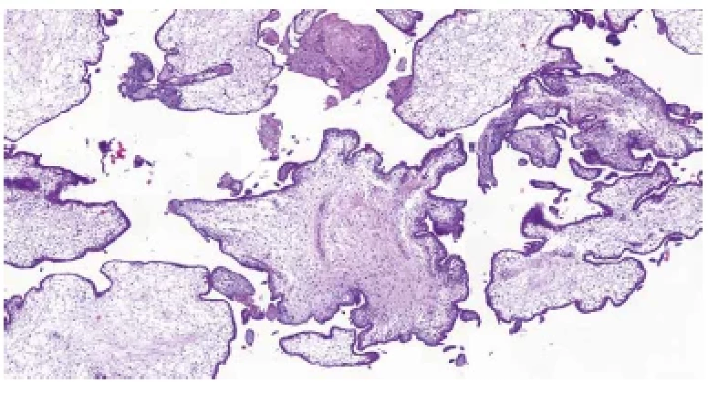 Trizomie chromozomu 21. Nepravidelný tvar choriových klků („irregularly
irregular pattern“) (HE, 50x).