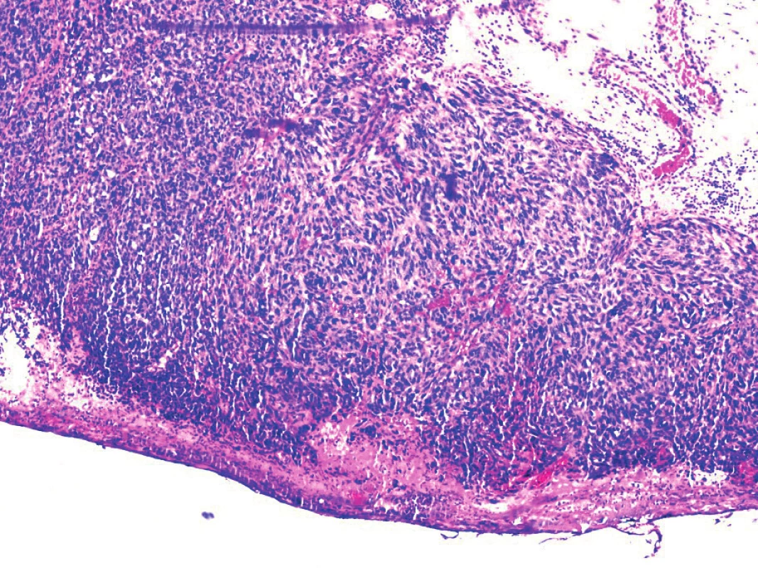 Melanoma of the vagina, histol.