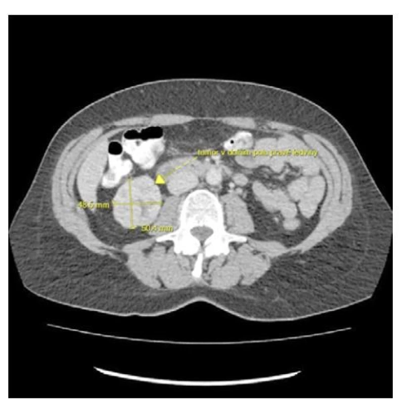 CT s kontrastní látkou, venózní fáze, transverzální
řez: částečně nekrotický tumor dolního pólu pravé
ledviny velikosti 5 cm; zdroj: Radiologické oddělení
Nemocnice Most<br>
Fig. 3. Contrast-enhanced CT, venous phase, transverse
section: partially necrotic tumor of the lower
pole of the right kidney with a size of 5 cm; source:
Department of Radiology, Most Hospital