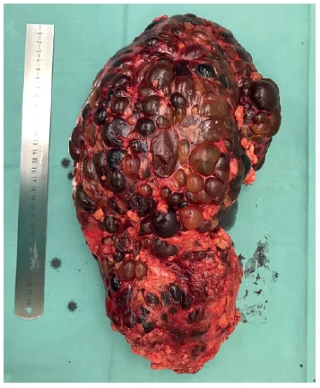 Nefrektomovaná pravá polycystická ledvina, váha
4760 g (zdroj: archiv autora) <br> 
Fig. 1. Native nephrectomy of right polycystic kidney,
weight 4760 g (source: author)