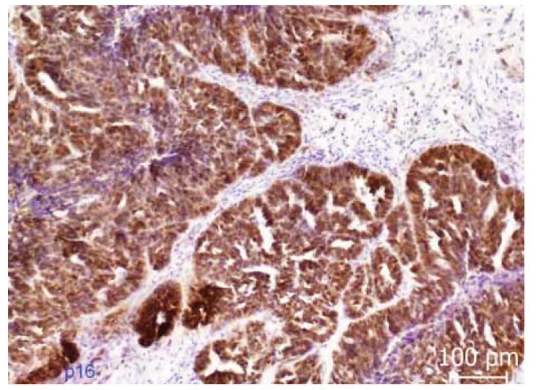 Imunohistochemická exprese p16. Difuzní cytoplazmatická i nukleární
exprese p16 (tzv. bloková pozitivita) v nádorovém epitelu.<br>
Fig. 4. Immunohistochemical expression of p16. Diffuse cytoplasmic and nuclear
expression of p16 (so-called block positivity) in tumor epithelium.