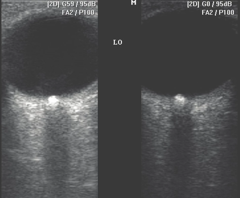 Left: Optic disc drusens B-scan ultrasonography in standard mode – gain
59 dB. Right: “halo” effect of optic disc drusens is minimised (drusens display in
actual size) when gain is reduced to 0 dB.