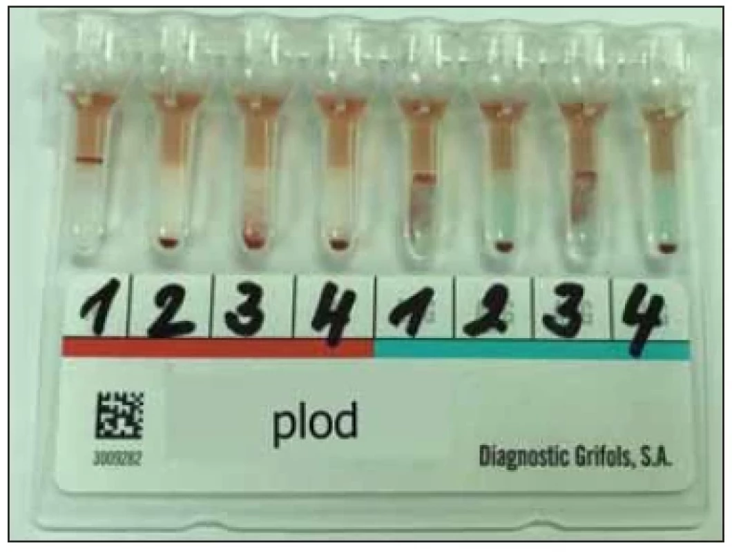 Screening protilátek plodu
(DG Gel Neutral/Coombs Grifols).