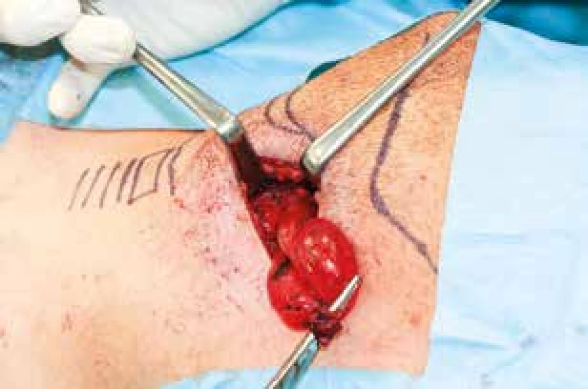 Resekce laryngokély – zevní přístup