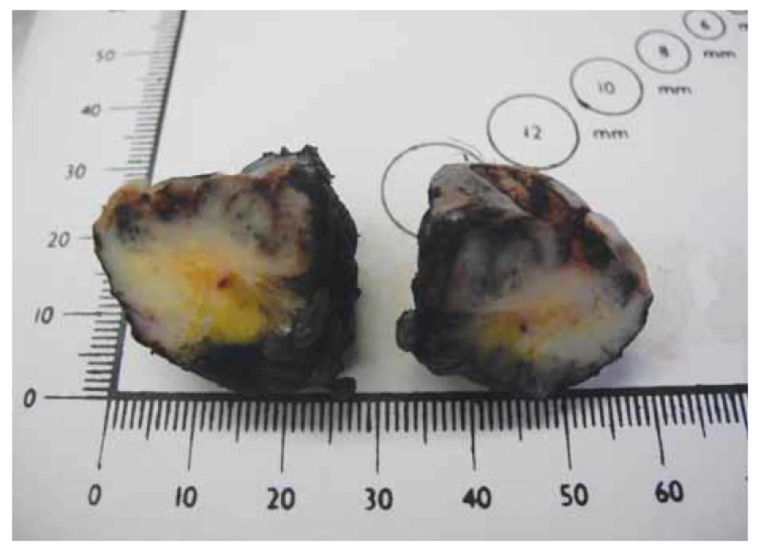 Excize pigmentované léze vulvy.<br>
Fig. 7. Excision of the pigmented vulvar lesion.