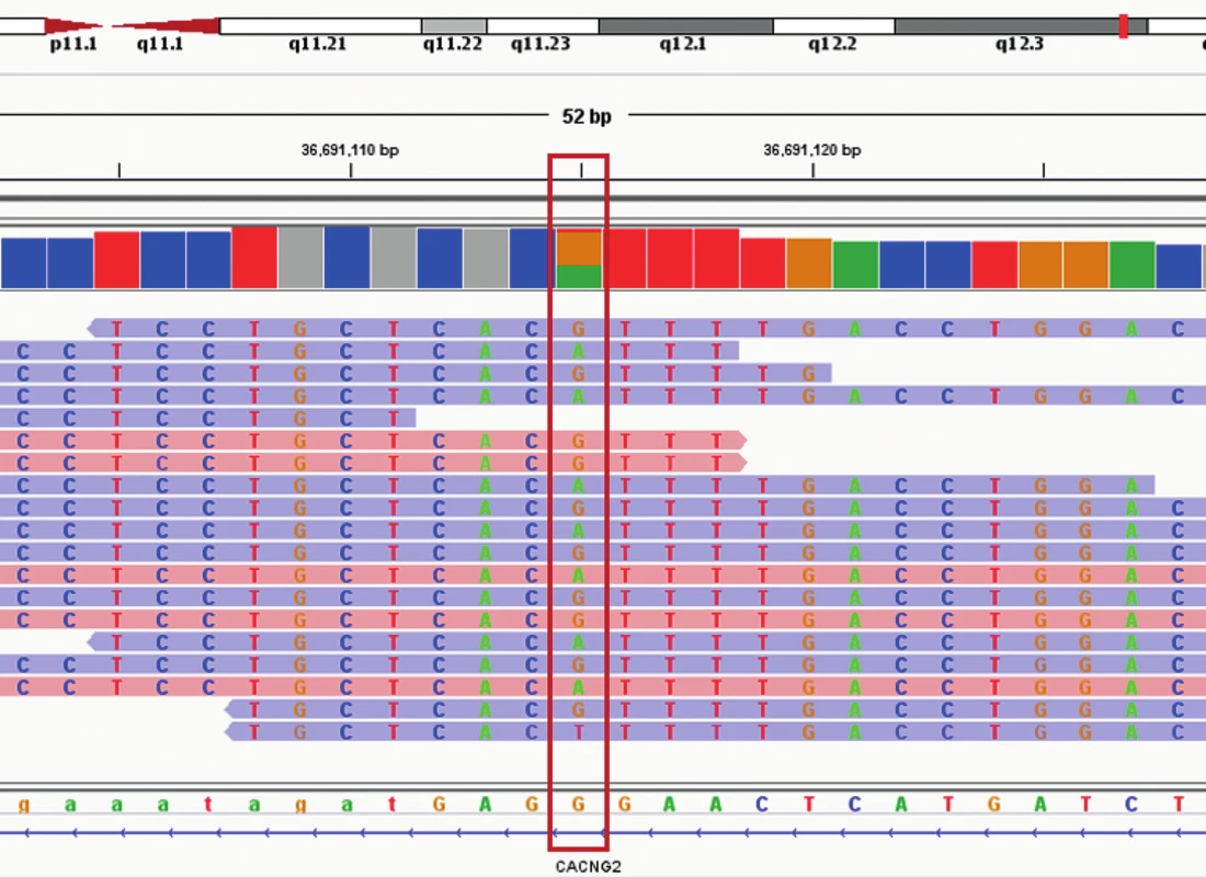 Vizualizace varianty c.3493C>T (g.36295069G>A) v genu MYH9 pomocí Intergrative Genomics Viewer (IGV). Nukleotidová sekvence je
označená červeným rámem. Sekvenační čtení forward jsou označeny modře a sekevanční čtení reverse růžovou barvou.