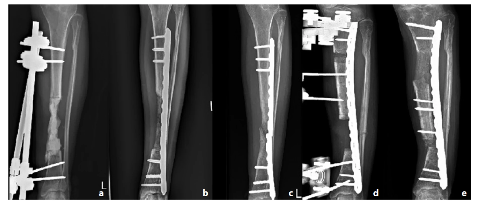 Pacient č. 7; a – PMMA spacer v místě defektu; b – 2 měsíce od spongioplastiky; c – patrná refraktura a selhání dlahy;
d – zvolena technika segmentálního kostního transportu; e – segmentální transport při dosažení kontaktu kostí<br>
Fig. 3: Patient 7; a – PMMA spacer inside the bone defect; b – 2 months after bone grafting; c – refracture and implant failure;
d – segmental bone transport applied; e – segmental bone transport after reaching the docking site.