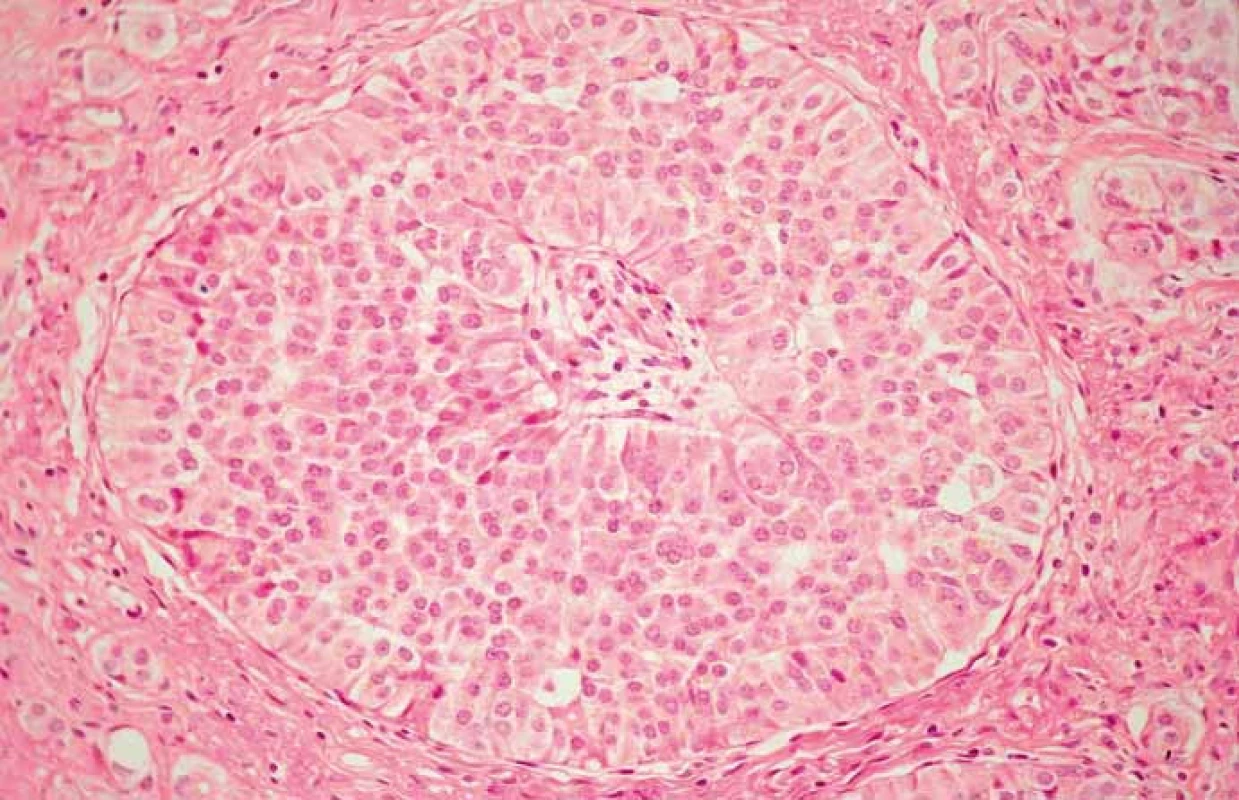 Neuroendokrinný nádor G1. Hematoxylín eozín, 400×.
