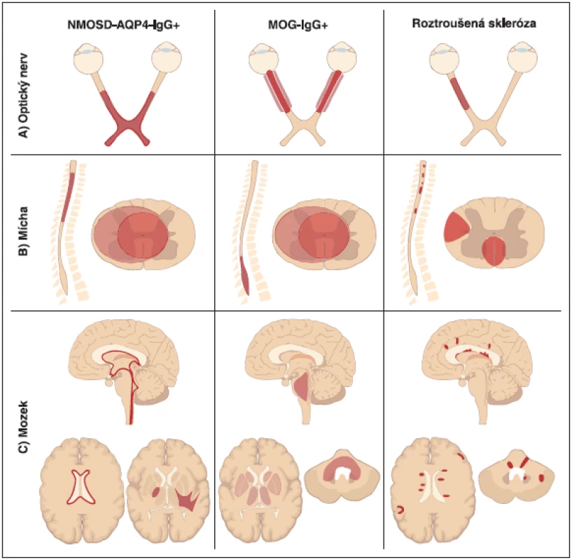 Schéma charakteru ložisek na MR diskriminující AQP4-IgGpozNMOSD, MOG-IgGpozNMOSD a RS (adaptováno z [8]).<br>
Fig. 11. MRI features of lesions in AQP4-IgGposNMOSD, MOG-IgGposNMOSD and MS patients (adapted from [8]).