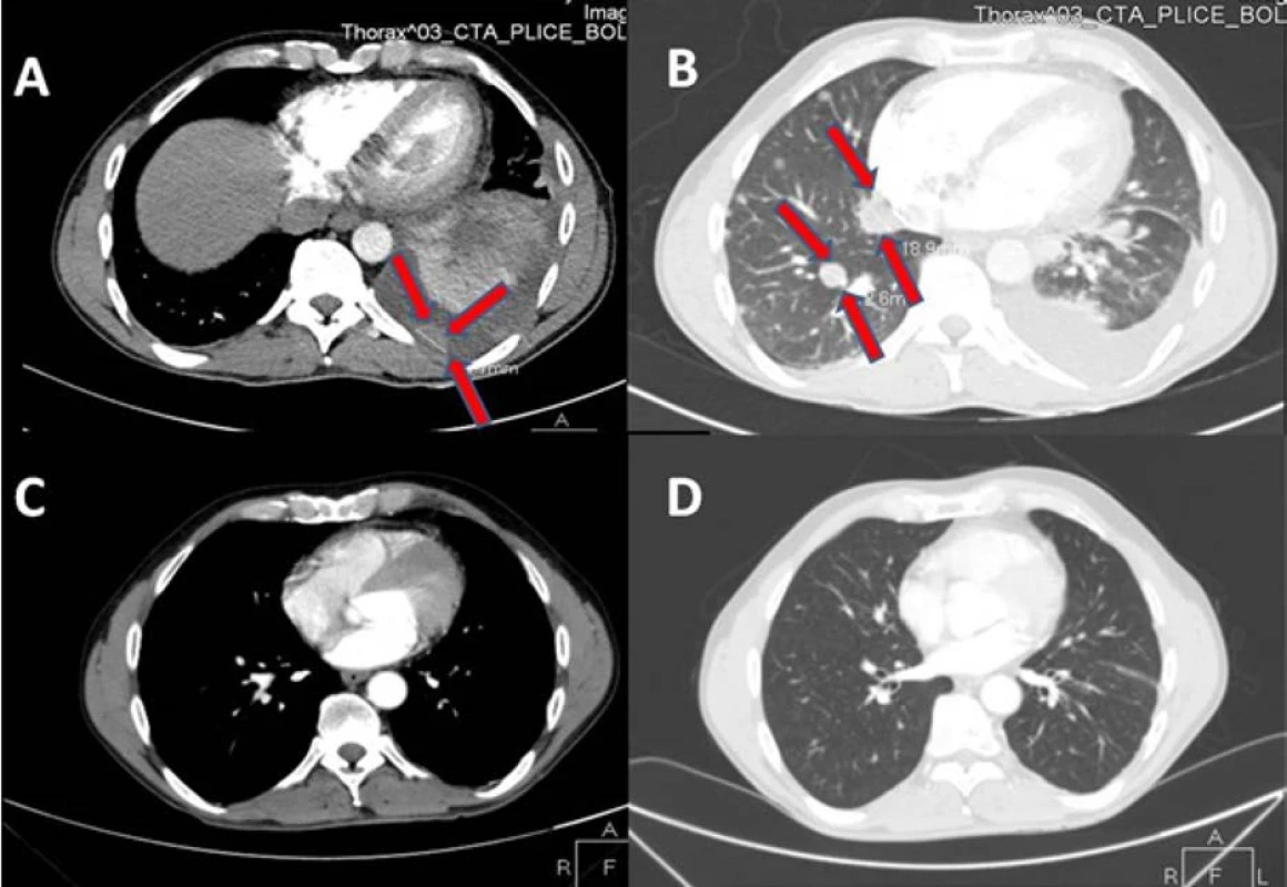 Na vstupním CT vyšetření plic je patrný sytící se tumor pleury (A) s rozsáhlým fluidotoraxem a dvě plicní
metastázy v pravém plicním křídle (B, na kontrolním CT za tři měsíce po léčbě sunitinibem regrese postižení pleury (C) i
plicních ložisek (D); na CT snímcích zobrazeny řezy v přibližně stejné úrovni; ložiska označena šipkami<br>
Fig. 1. Initial CT scan of the lung demonstrates a pleural metastasis (A) with pleural effusion. There are two
metastases in the right lung base (B). CT three months after treatment with sunitinib demonstrates regression of
the pleural (C) and pulmonary metastases (D). Slices at approximately the same level are displayed on CT images.
Metastases indicated by the arrows