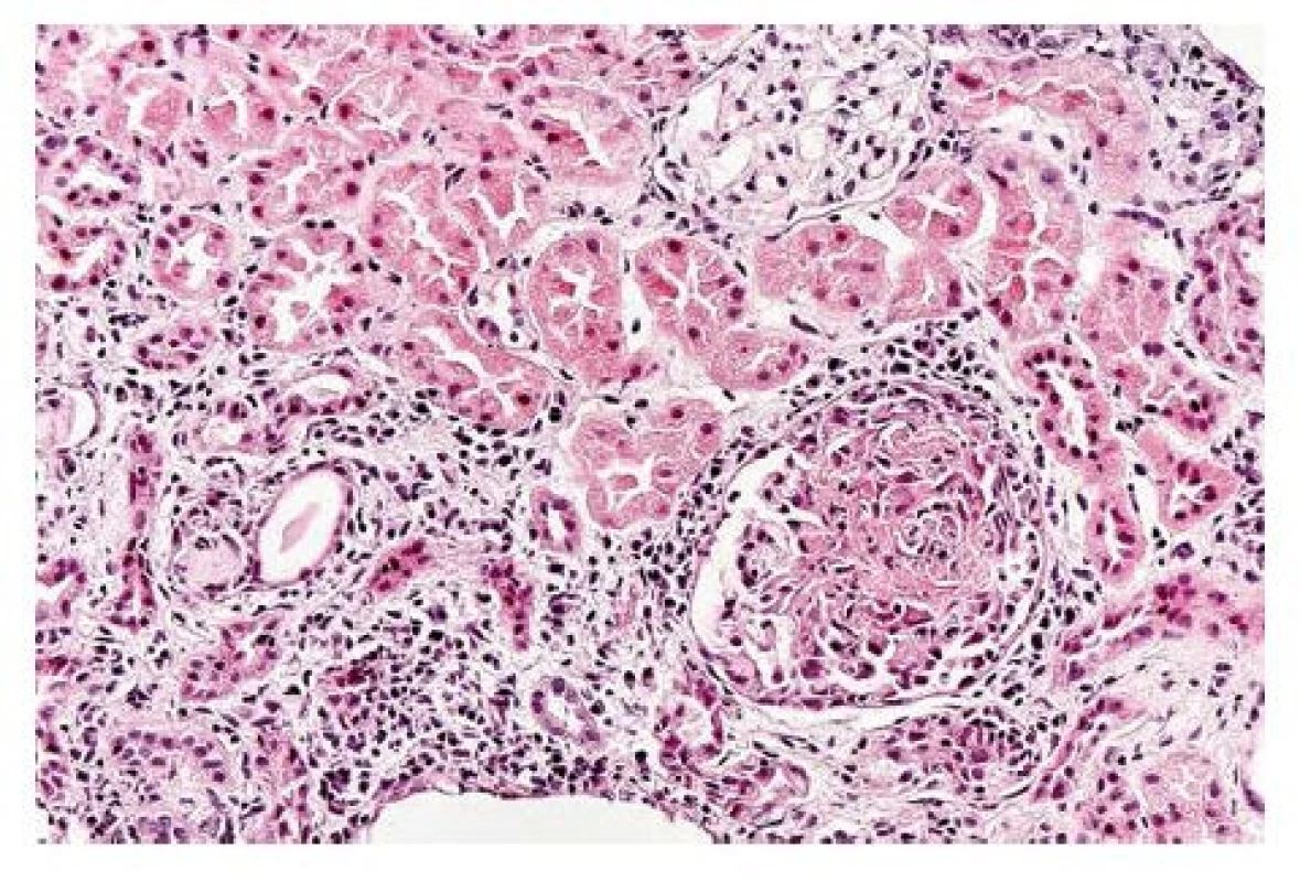 Biopsie ledviny se zastiženým glomerulem, ve kterém je čerstvá segmentální nekróza organizující se bunĕčným srpkem (hematoxylin-eosin, zvĕtšení 200x) (archiv FinIerlandova ústavu patologie Hradec Králové)
