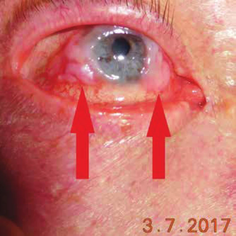 Klinický obraz pacienta so skvamocelulárnym karcinómom
bulbárnej spojovky
