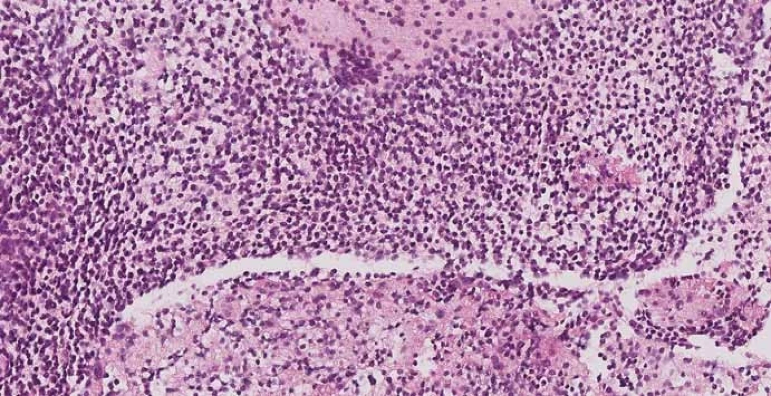 Pancreatic biopsy obtained via EUS-FNA, magnification ×200, haematoxylin and eosin stain. Hypercellular sheets of malignant cells with hyperchromatic nuclei and scant cytoplasm. The morphology of these cells is not typical of a melanoma. Immunohistochemistry is required for a correct diagnosis.<br> Obr. 4. Biopsie pankreatu získaná EUS-FNA, zvětšeno 200×, základní barvení hematoxylin/eozin. Nátěry maligních buněk s hyperchromatickými jádry a chudou cytoplazmou. Morfologicky se nejedná o typické buňky melanomu, k získání správné diagnózy je nutné doplnit vyšetření pomocí imunohistochemie.
