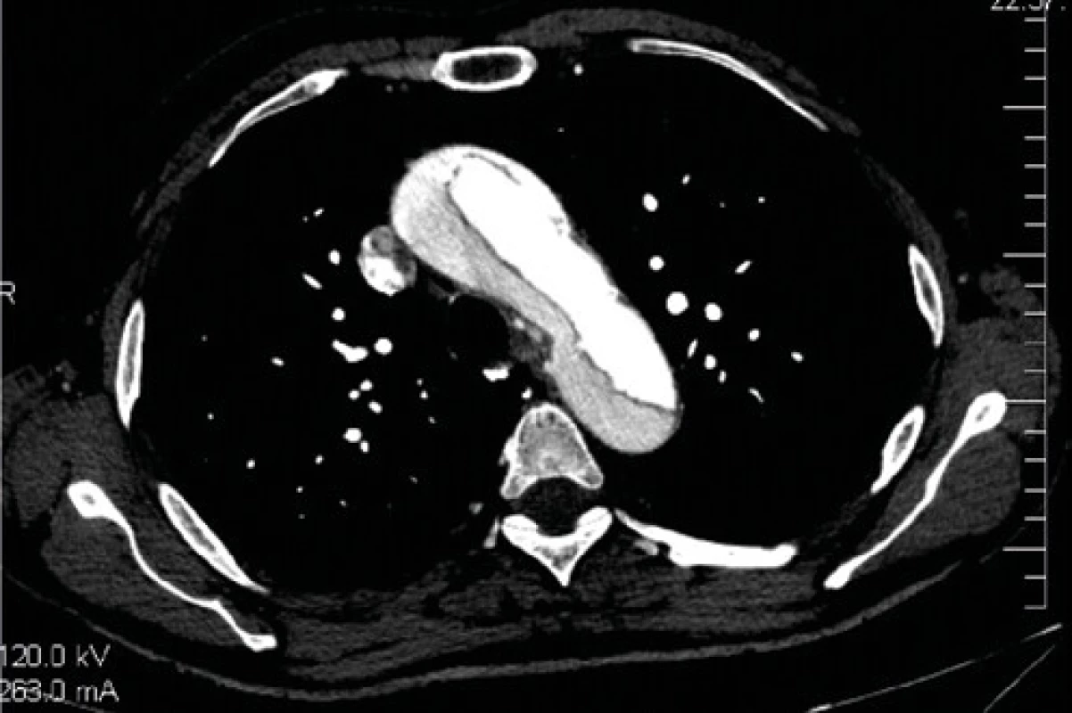 CT vyšetrenie, ascendentná aorta