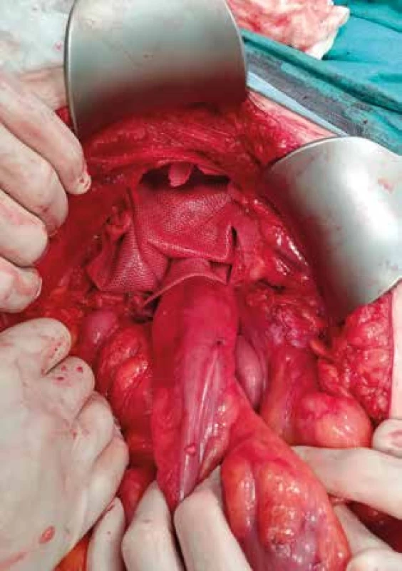 Náhrada pánevního dna, tvořená nesmáčivou síťkou<br>
Fig. 2: Pelvic floor replacement formed by a non-adhesive
mesh