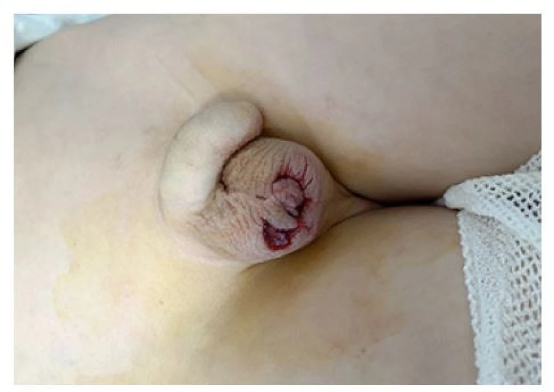 a. Tržná rána šourku způsobená úrazem o větev
stromu<br>
Obr. 3a. Laceration of the scrotum caused by an
accident on a tree branch