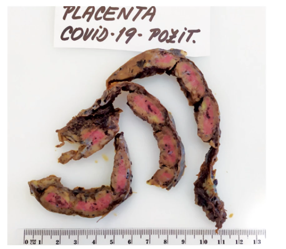 Makroskopická patologie placenty s patrnou signifikantní
abundancí fibrinoidu, postižená je většina placentární
tkáně – placenta výrazně tuhé konzistence