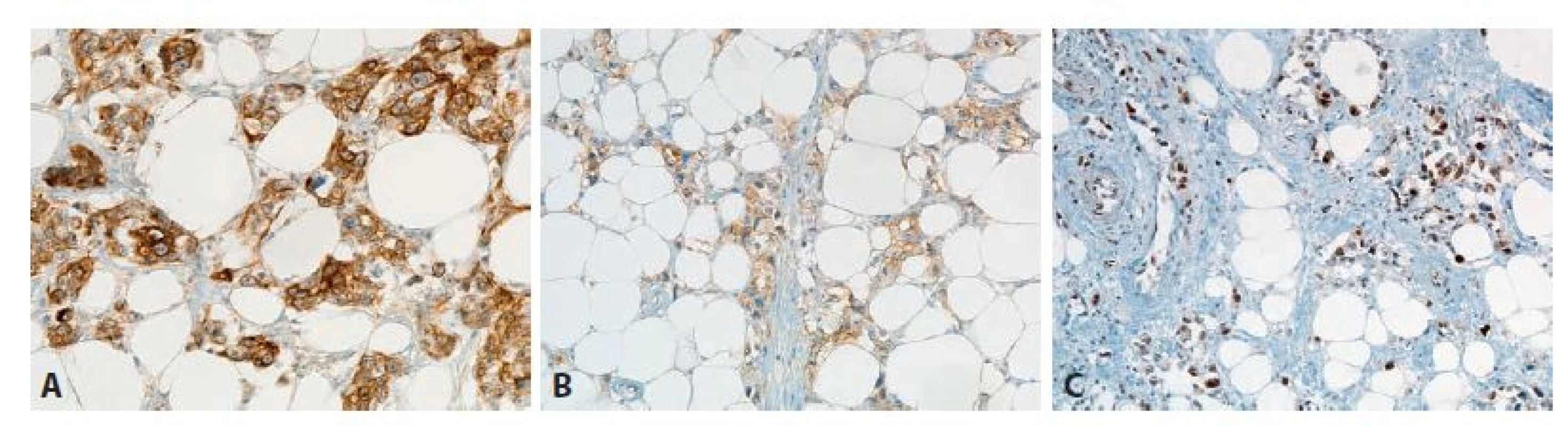 A: Silná difuzní exprese cytokeratinu 7 v prakticky všech nádorových elementech (400x); B: Slabá až středně silná exprese BER-EP4 ve valné většině
buněk (200x); C: Průkaz Ki67 je pozitivní ve více než 50 % buněk. Pozitivní průkaz tohoto proliferačního markeru potvrzuje zachovalost antigenů a tím i použitelnost
parafi nového bločku pro dodatečné imunohistochemické vyšetření.