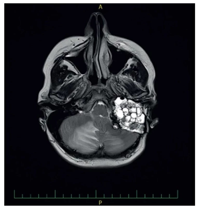 MRI: Solidně – cystická masa pyramidy.