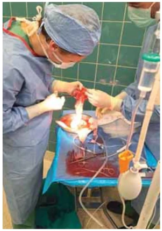 Príprava resekátu pred konzerváciou,
preplach Custodiolom a transportom
na IKEM pracovisko. <br> 
Fig. 2. Preparation of the resected part before
conservation, fl ushing with a Custodiol
and transport to the IKEM workplace.