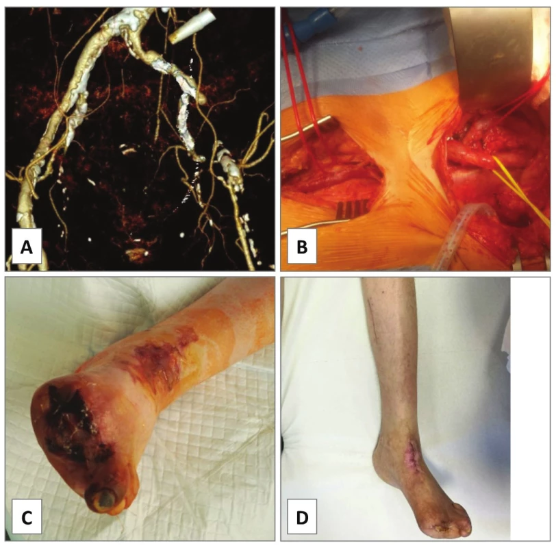 Iliac-femoral endarterectomy, case 4