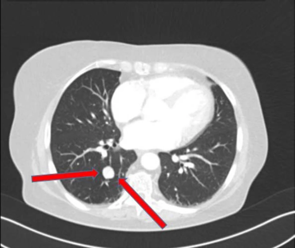 Metastáza v plicích při
restaging dle CT vyšetření z druhé poloviny
července 2017<br>
Fig. 4. Metastasis in lungs in restaging –
CT July, 2017