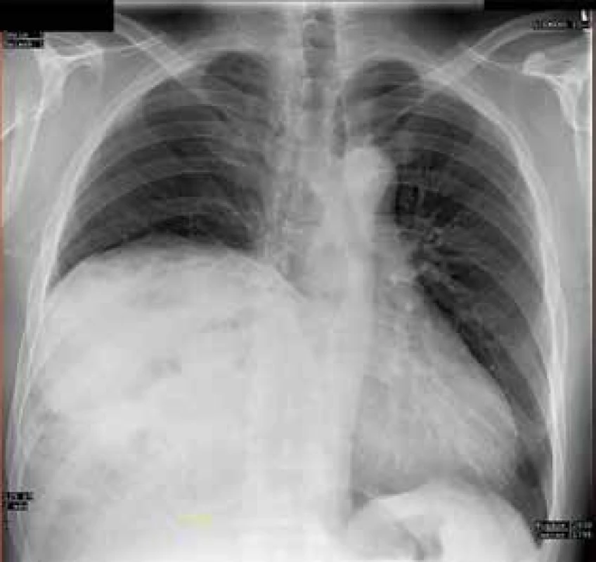 Předoperační RTG hrudníku, kde nález imitoval
parézu bránice<br>
Fig. 2: Preoperative chest X-ray where the finding imitated diaphragmatic paresis 