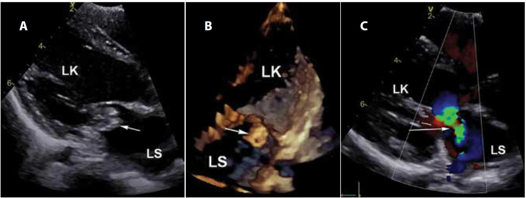 Echokardiografie: a) vegetace na mitrální chlopni, 2D obraz, dlouhá osa levé komory; b) vegetace v obraze 4D, čtyřdutinová
projekce; c) významná regurgitace chlopně, barevné dopplerovské zobrazení (LS: levá síň, LK: levá komora).
Fig. 1. Echocardiography: a) the mitral valve vegetation, 2D image, long axis of the left ventricle; b) vegetation in 4D image, fourchamber
scan; c) significant regurgitation of the valve, Doppler colour flow mapping (LS: left atrium, LK: left ventricle).