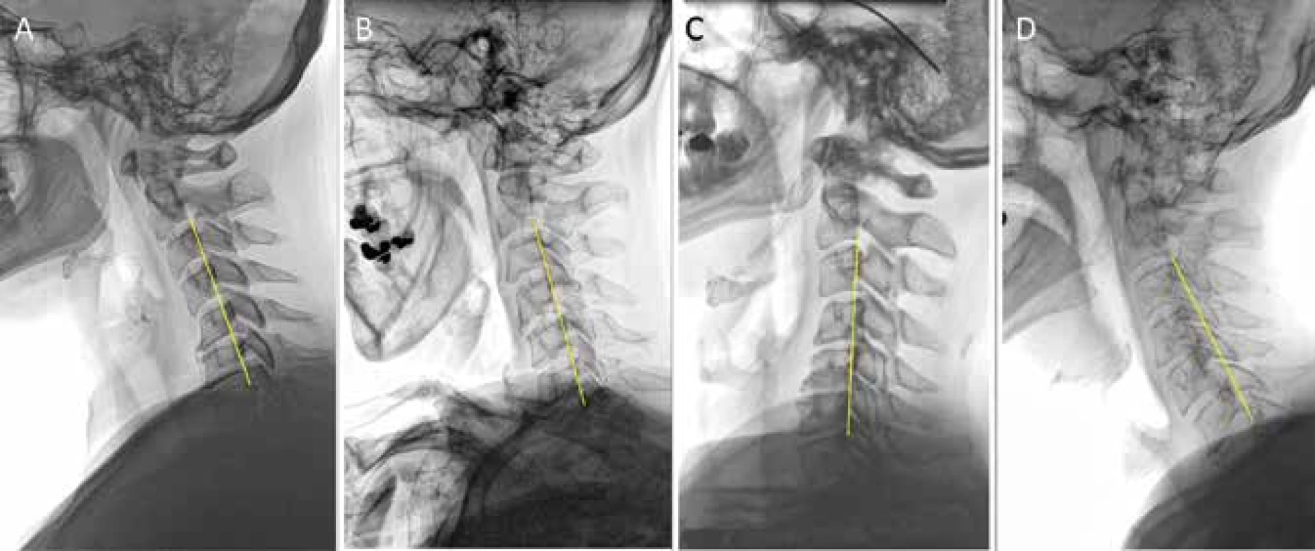 Tvar zakřivení krční páteře dle Toyamy – A kyfotický, B rovný, C esovitý, D lordotický<br>
Fig. 3: Cervical spine alignment according to Toyama – A kyphotic, B straight, C sigmoid, D lordotic