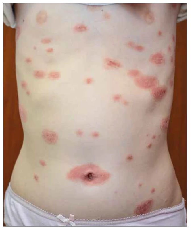 Plaková psoriáza u 8leté dívky. [Foto: archiv autorky]