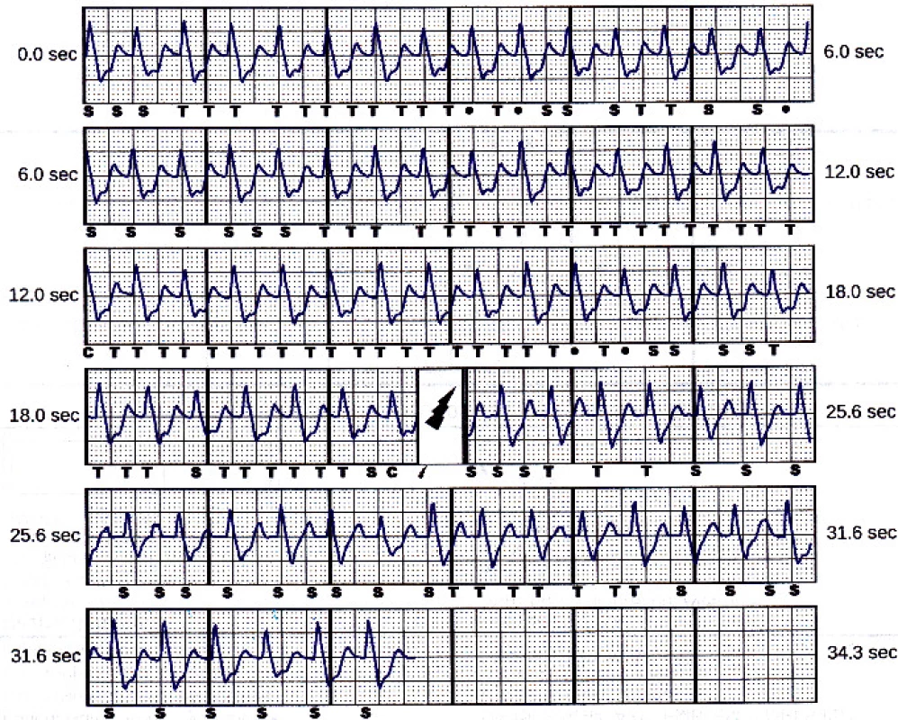 Treated episode saved in the device memory.
Beats marked “S” are sensed (below the tachycardia
detection zone), beats marked “T” are in tachycardia
zone, “C” means charge started. The symbol of flash
stands for the delivered shock.