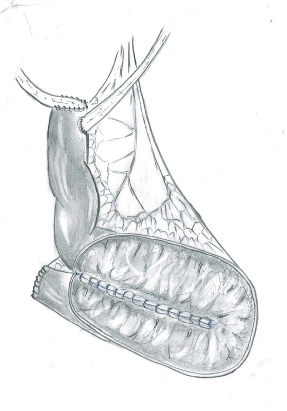 Ileální neovezika otevřena v původní sutuře<br>
Fig. 2. The ileal neobladder was opened in the line of
previous suture