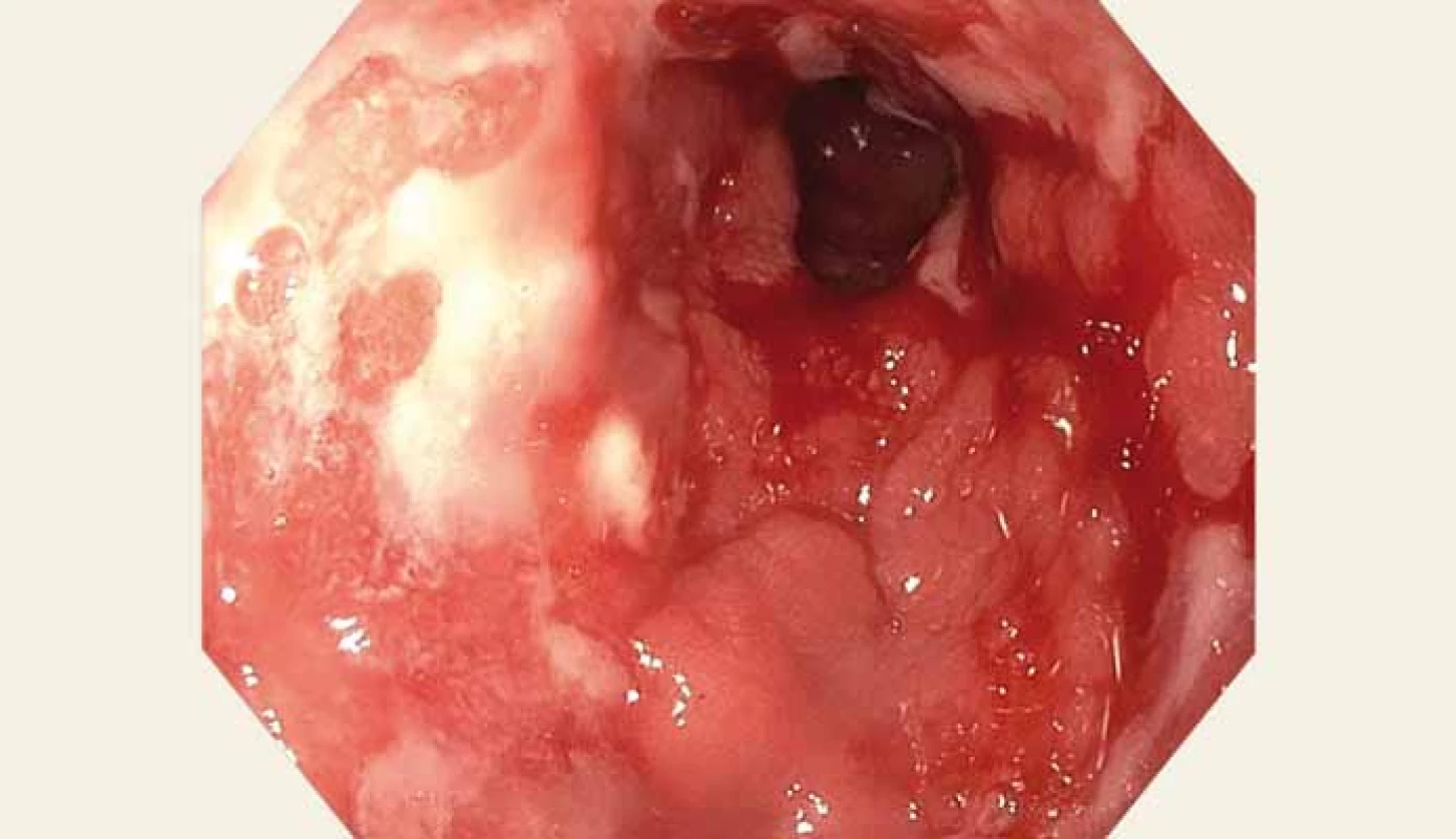 Sliznice žaludku – antrum, pylorus – ploché ulcerace s fibrinovými povlaky,
přechodné spontánní krvácení.<br>
Fig. 5. Gastric mucosa – antrum, pylorus – flat ulcerations with fibrin coatings,
transient spontaneous bleeding.