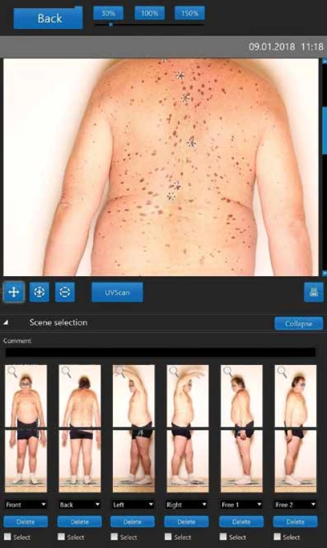 Detailní náhled a výběr rizikových pigmentových lézí